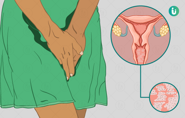 علائم و نشانه‌های عفونت قارچی واژن چیست؟