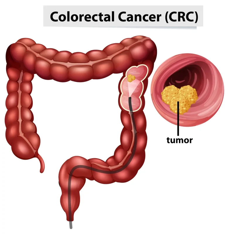سرطان روده بزرگ (کولورکتال)