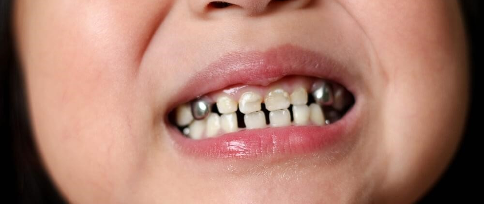 انواع شکستن دندان کودکان