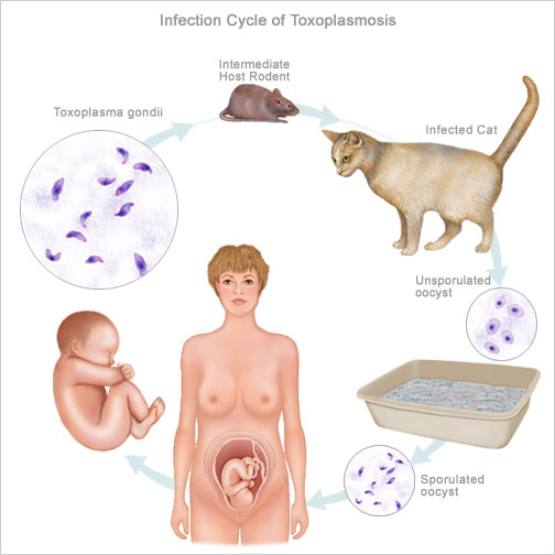 عفونت مادرزادی توکسوپلاسما