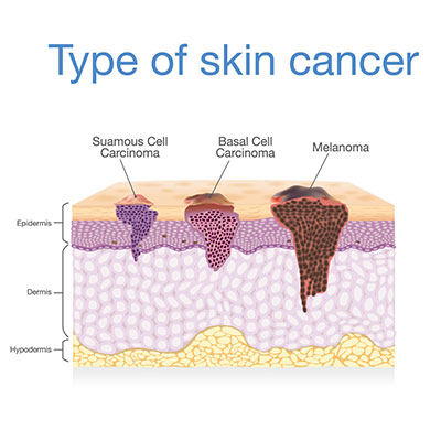 سرطان پوست زنان