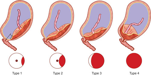 جفت سرراهی   Placenta Previa