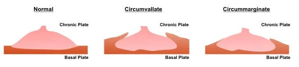 جفت اکستراکوریال  Extrachorial Placenta