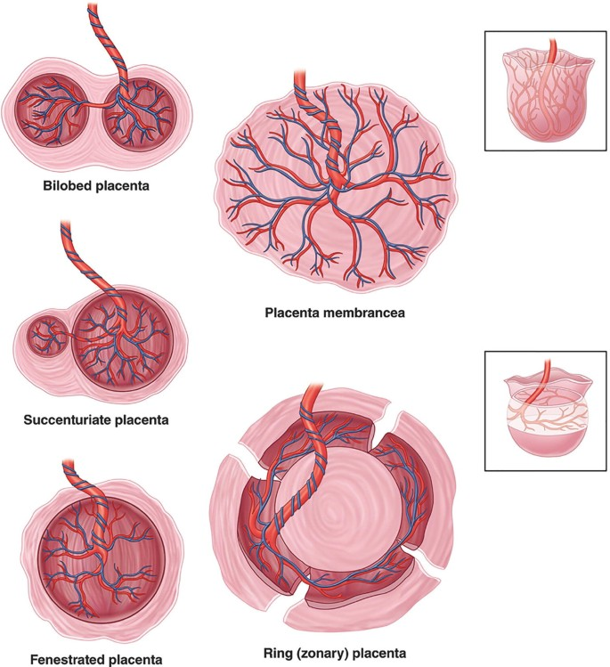 جفت فنستراتا (جفت غربالی یا مشبک)  Placenta Fenestrata