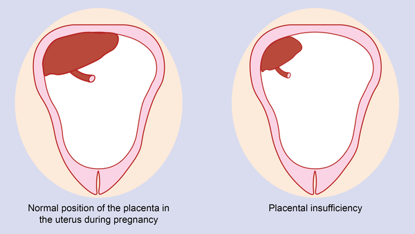 نارسایی جفت  Placental Insufficiency