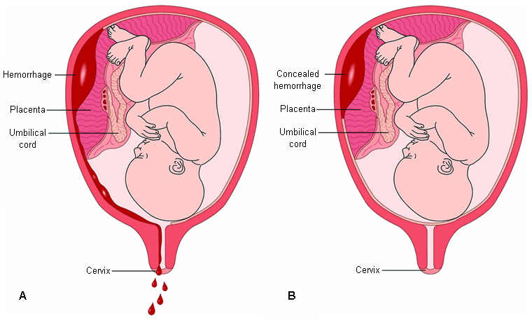 جفت جدا شده دکولمان  Placental Abruption