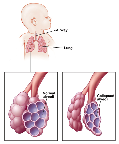 درمان نشانگان دیسترس تنفسی نوزادان NRDS