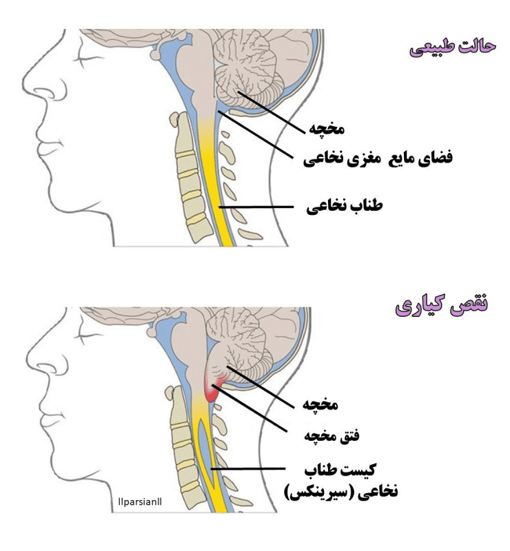 عوامل خطر برای ایجاد سندرم چیست؟