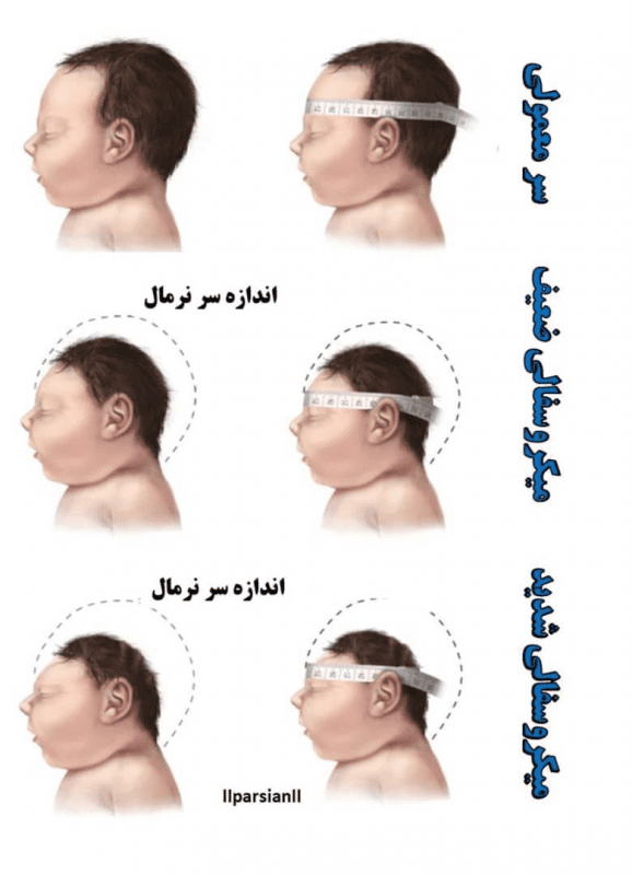 میکروسفالی چگونه تشخیص داده می‌شود؟