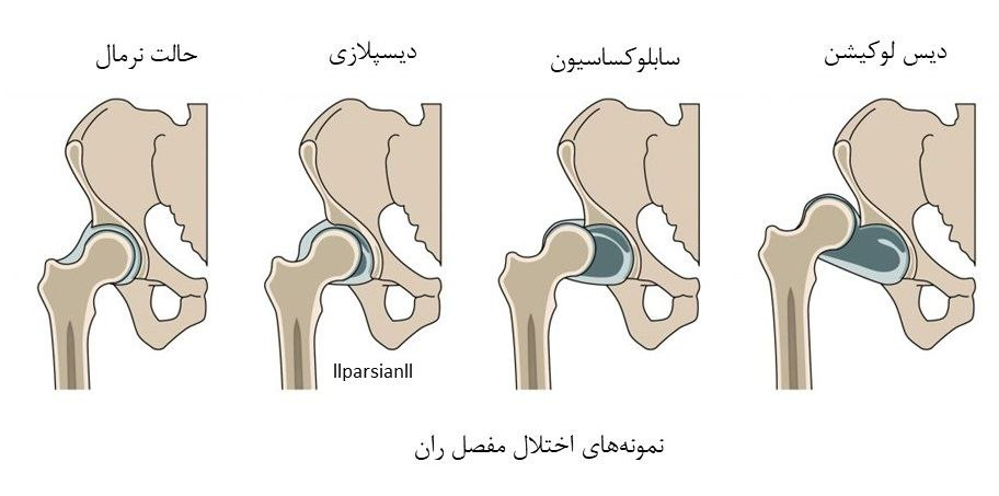 اصطلاحات مربوط به مشکلات رشدی لگن