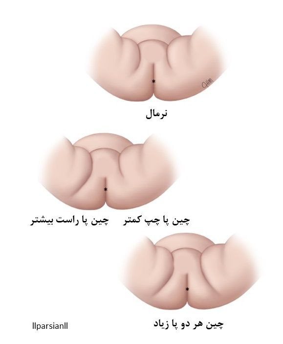 عدم تقارن در چین پوستی