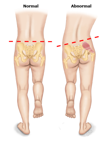 تست ترندلنبرگ (Trendelenburg Test)