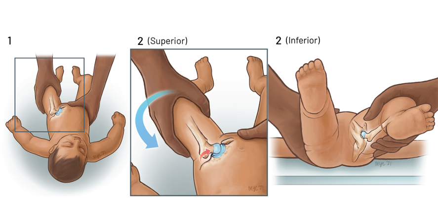 مانور اورتولانی (Ortolani Maneuver)