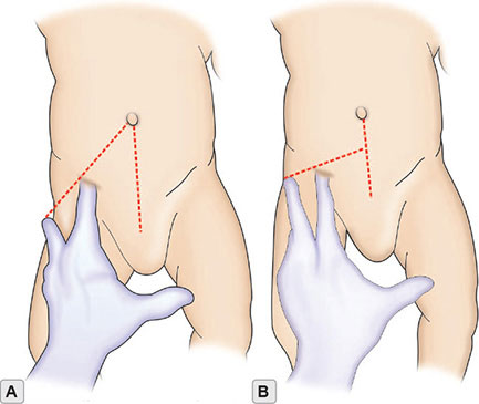 تست کلیسیک (Klisic Test)