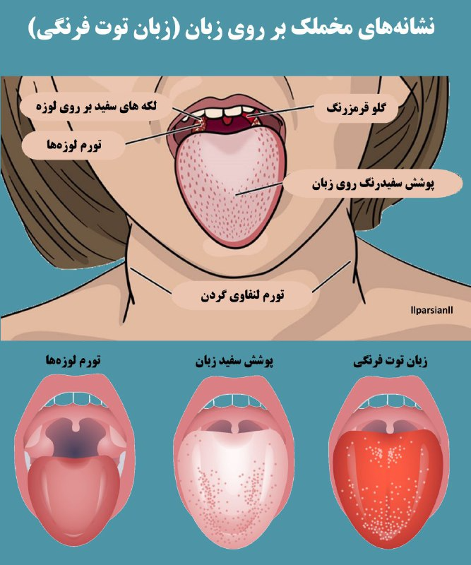 علائم مخملک در دهان و گلو