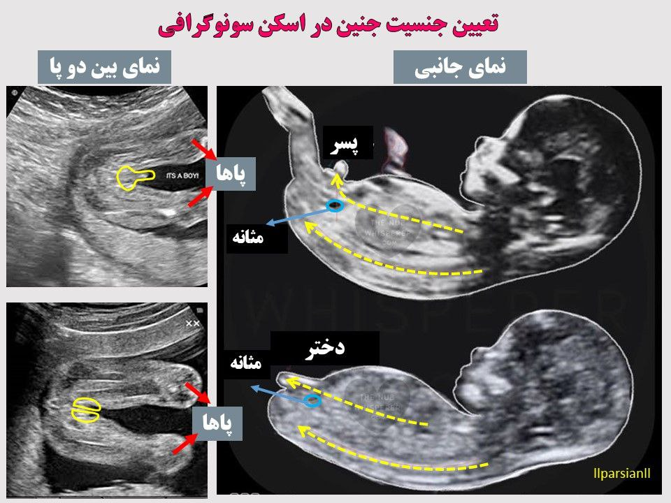 تعیین جنسیت جنین از روی تصویر سونوگرافی