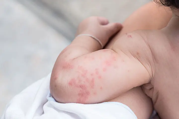 آلرژی پوستی در نوزادان