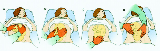 مانور چهارم لئوپولد - گرفتن ناف (Umbilical Grip) چگونه انجام می‌شود؟