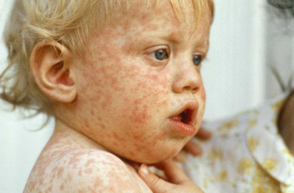 سرخک Measles