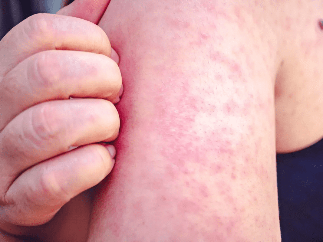 سرخجه یا سرخک آلمانی Rubella