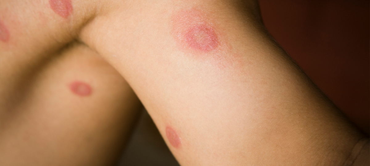 کرم حلقوی Ringworm