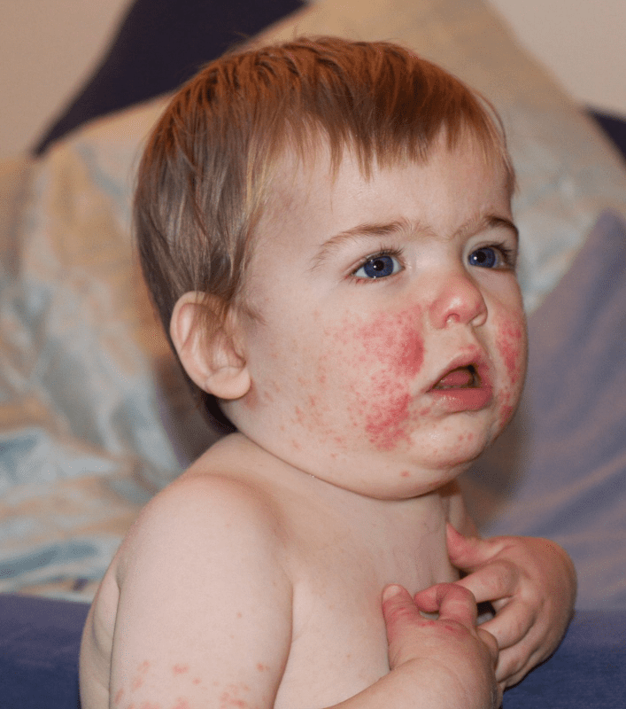 سیلی روی گونه یا بیماری پنجم Slapped Cheek or Fifth Disease