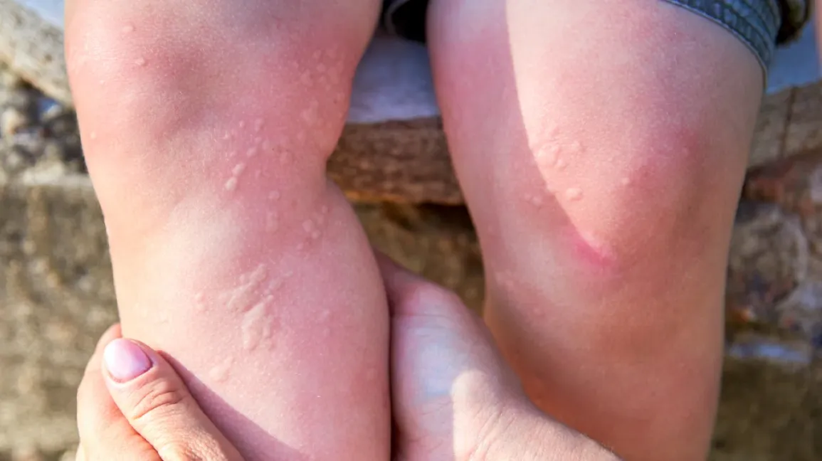 کهیر Hives / Urticaria