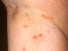 گال Scabies