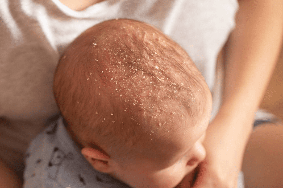 کلاه گهواره Cradle Cap