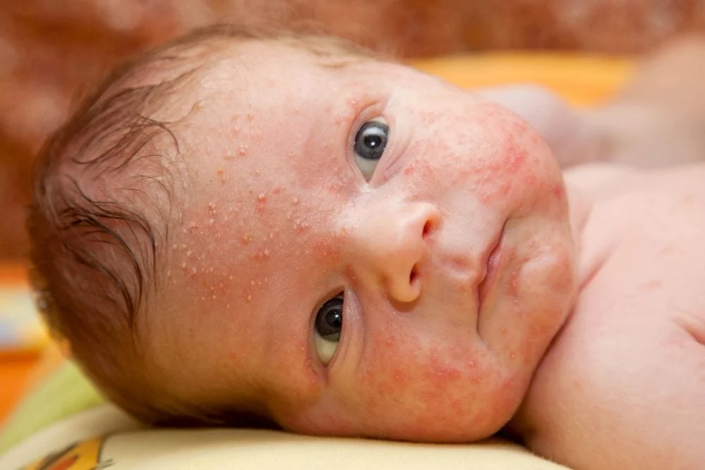 آکنه نوزاد Baby Acne