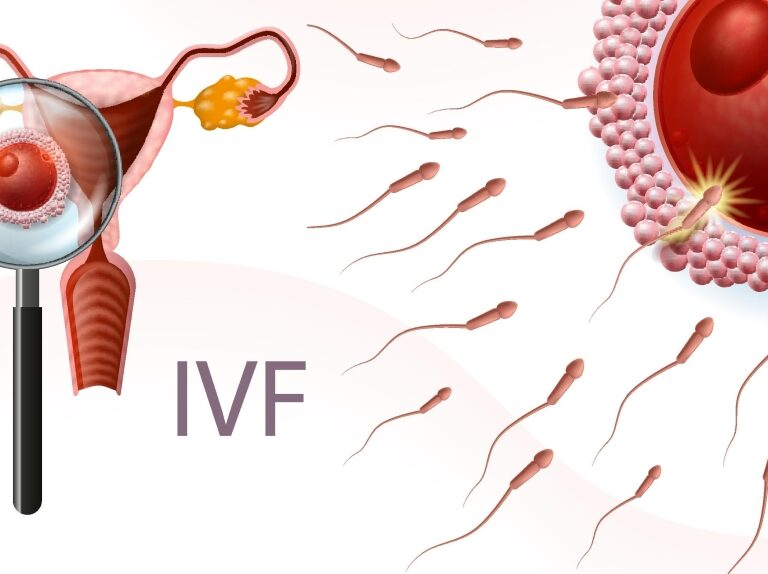 انواع IVF و همه آن چه که باید در مورد روش IVFبدانید